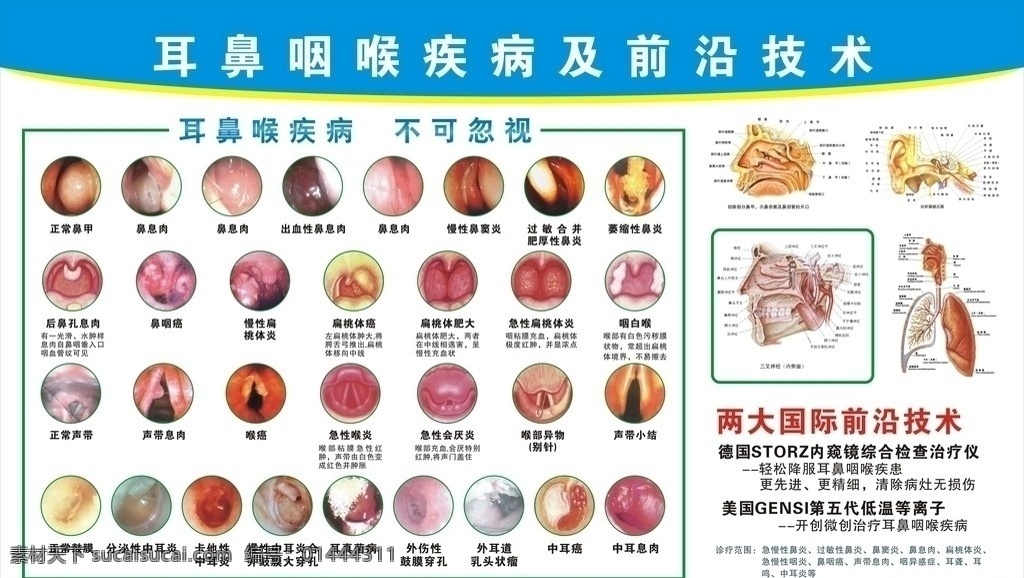 耳鼻咽喉 疾病 掛圖 疾病掛圖 鼻息肉 鼻竇炎 前沿 技術(shù)