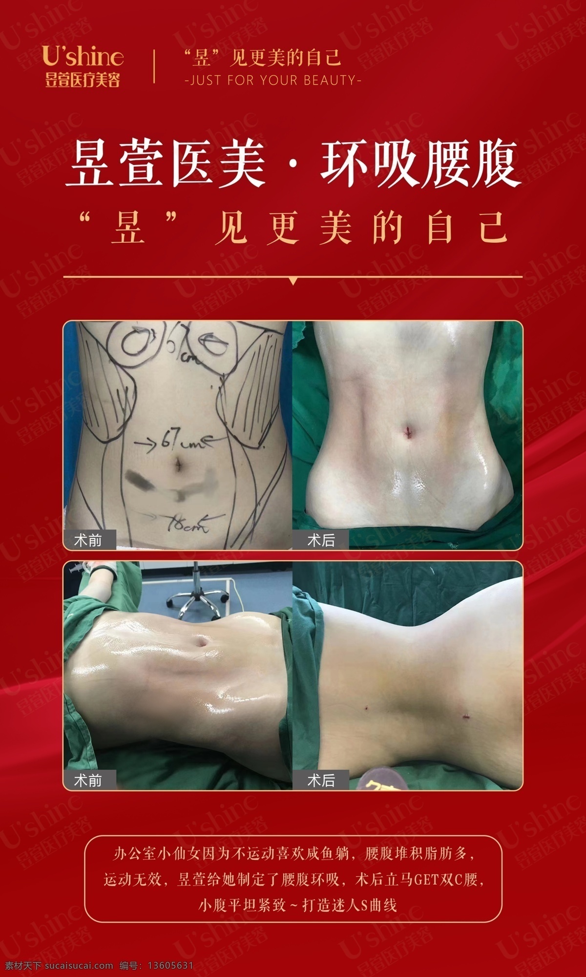 醫(yī) 美 整形 醫(yī)院 案例 對比 海報 醫(yī)美 整形醫(yī)院 案例對比 術(shù)后