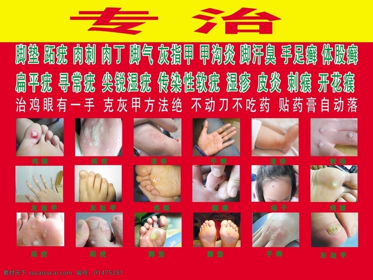 专治手足癣 专治 鸡眼 瘊子 分层 写真