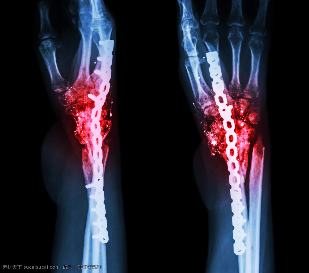 x光底片 x射线 骨骼 关节扫描 底片 x射线扫描 医院 医疗 医学 病人 医疗护理 现代科技