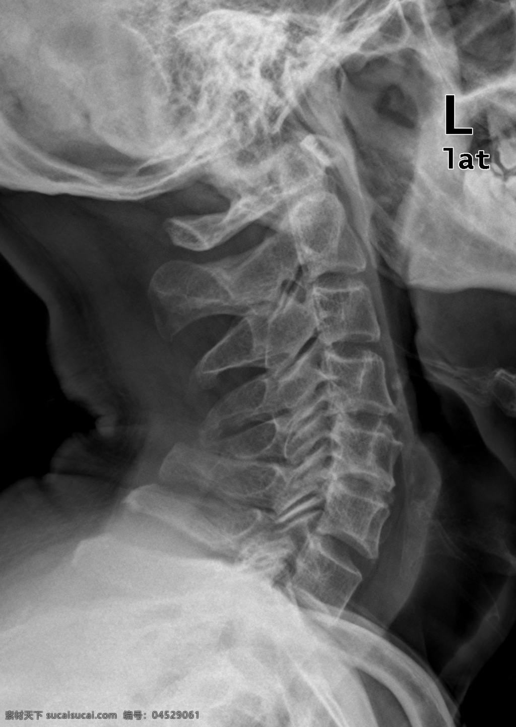 颈侧位 骨科 医生 x光 颈侧位骨科 医疗护理 现代科技