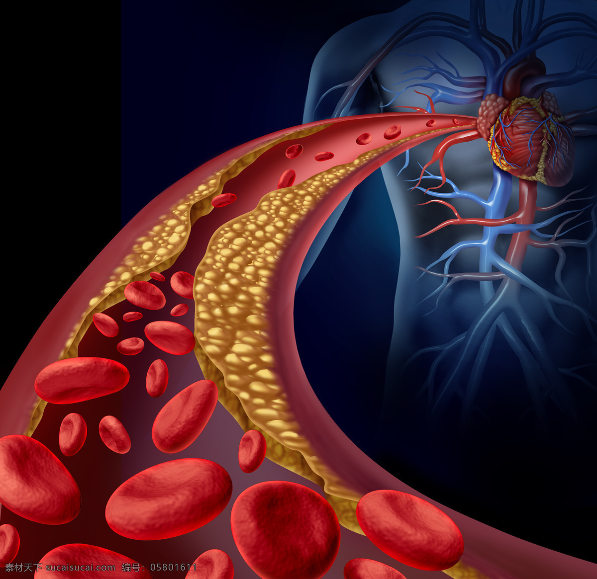 血管疾病 动脉 血红细胞 血管 粥样动脉硬化 3d 医学研究 血液 科学 显微状态 心脏 现代科技 医疗护理
