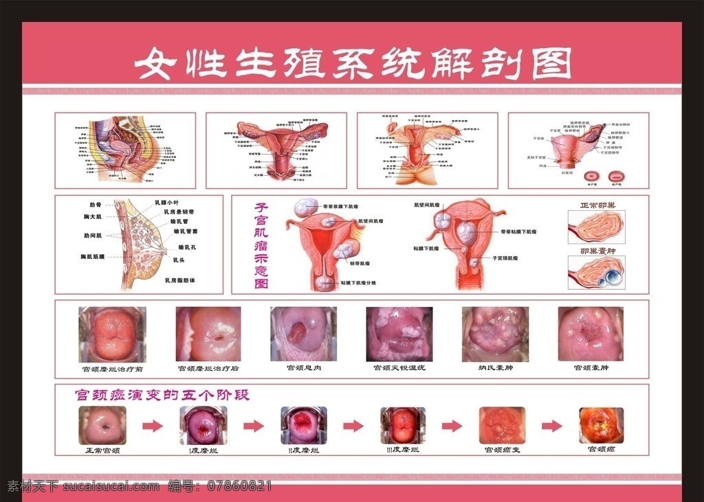 医院展板 红色展板 女性 生殖 系统 解剖 图 子宫肌瘤 示意图 女性健康 展板模板 矢量