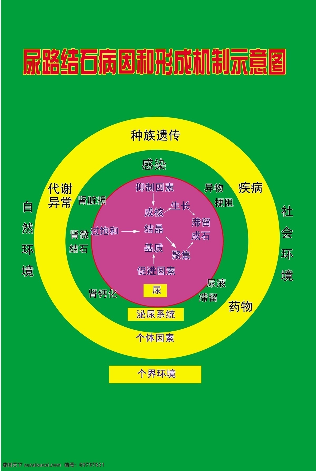 尿 路 结石 病因 形成 机制 示意图 医院 尿路结石 psd源文件