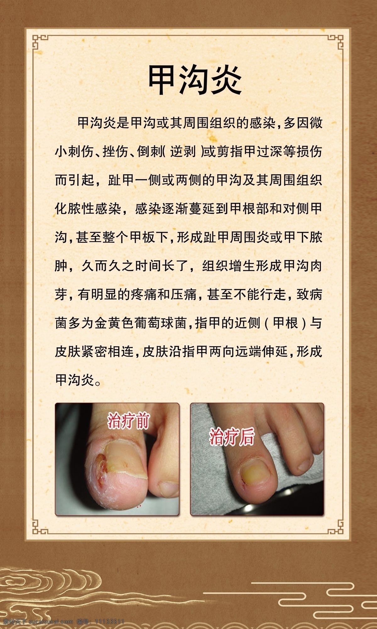 甲沟炎 足疗 足浴 泡脚 灰指甲 脚指 中医 中药 室内广告设计