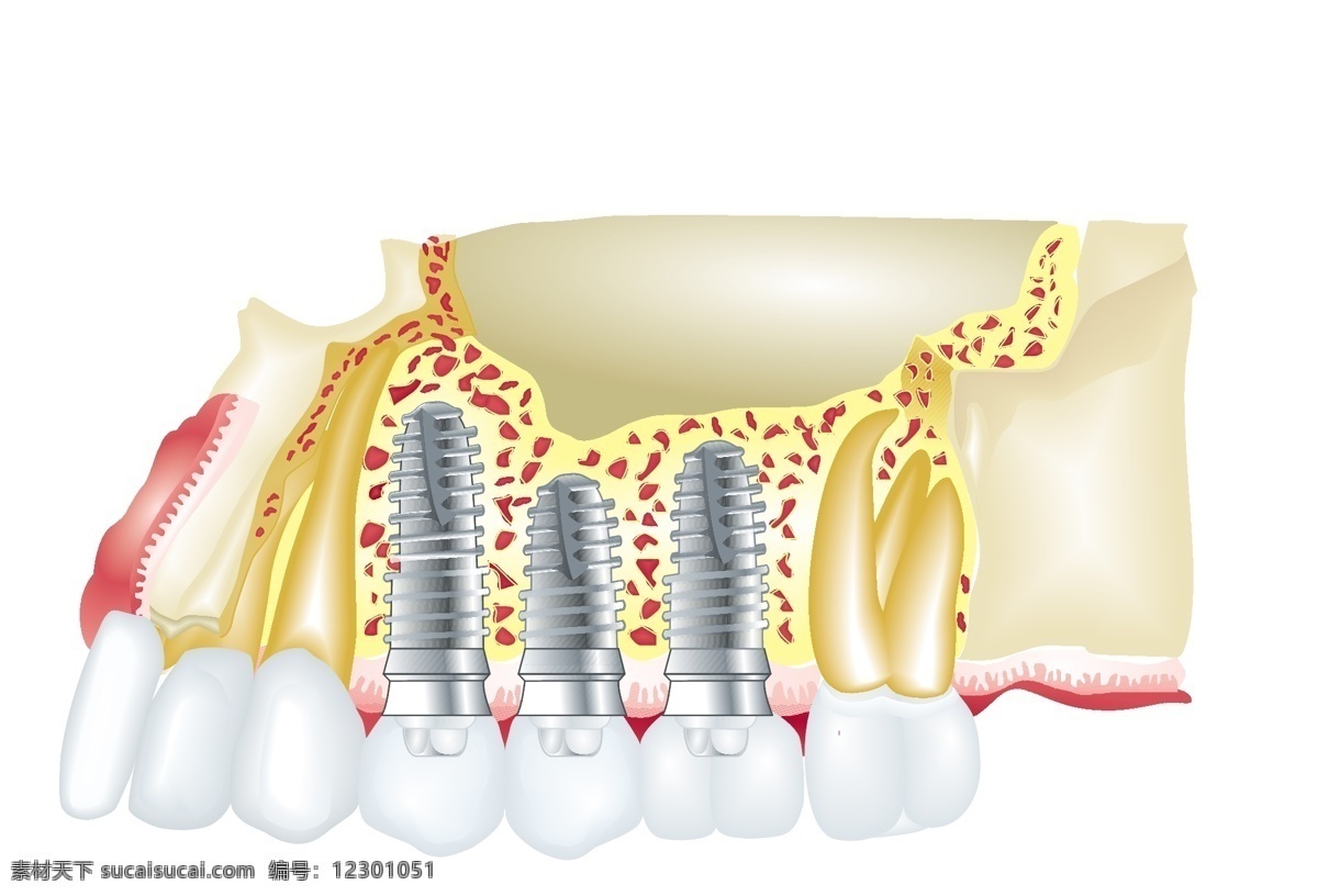 镶牙 示意 平面图 矢量 ai格式 人体器官 牙科标志 牙齿固定 牙科图标 补牙图案 脊椎动物 高度 钙化 组织 矢量图 日常生活