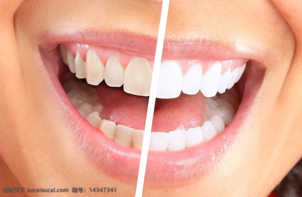 白黑牙齿对比 健康牙齿 美牙 美齿 牙齿 美女牙齿 女性女人 人物图库